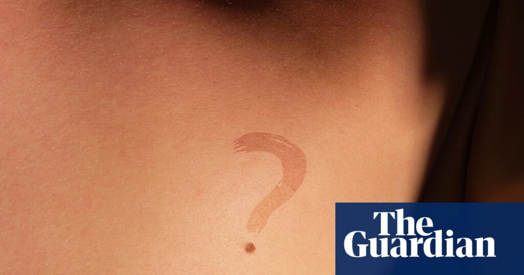Sali Hughes on beauty: I make no apologies for repeating myself – keeping track of your moles is vital | Skincare